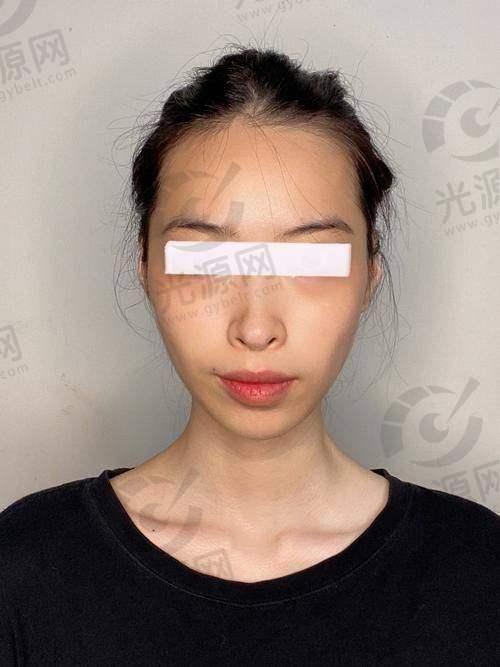 下颌角截骨后脸还是特别方的原因之二：医生的技术水平