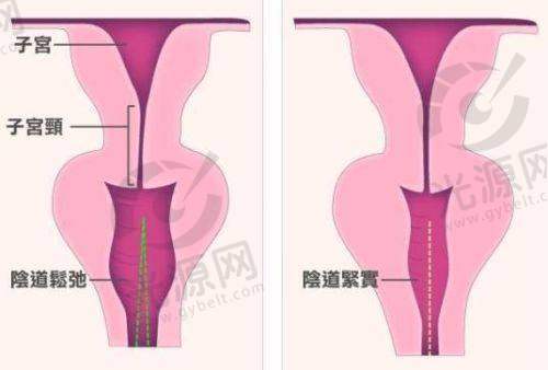 总结：打紧缩针的价值