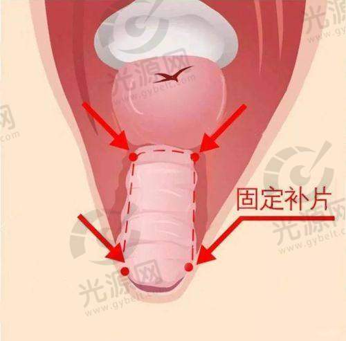 打紧缩针的适用医院