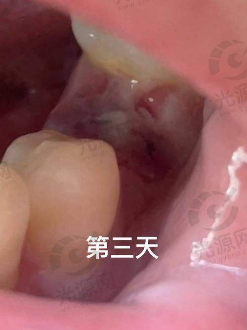 拔牙私人贵还是医院贵的费用对比