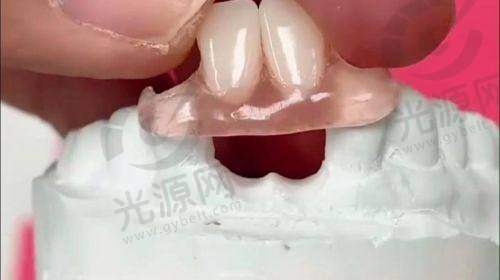 隐形义齿的使用寿命和更换周期