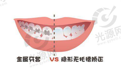 门牙外凸不建议再矫正了？门牙外凸矫正方法解析：隐形牙套适合哪些人群？注意事项与年龄限制全解读！