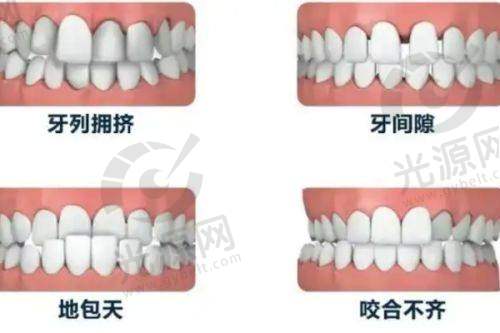 门牙外凸不再矫正的其他解决方法