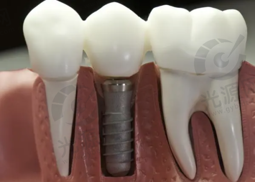 使用寿命对比：登腾和奥齿泰哪个好更持久？