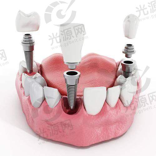 质量对比：登腾和奥齿泰哪个好？
