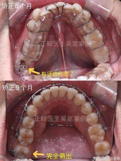 门牙突出更快矫正方法的注意事项