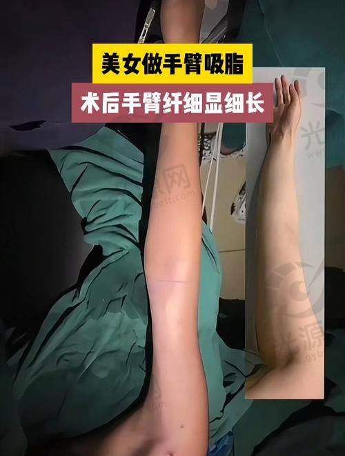 蝴蝶袖手臂图片上的心理影响