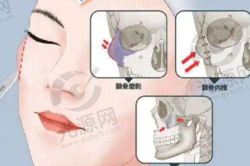 实例分享：液态水分子丰胸的真实体验