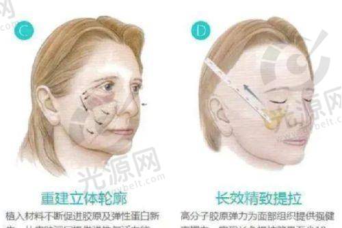 手术剥离法的印第安纹剥离手术价钱