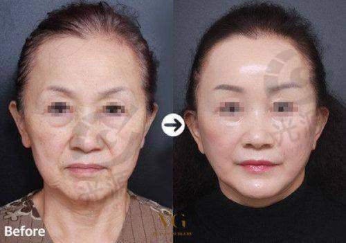 绿毒瘦脸针的适用人群