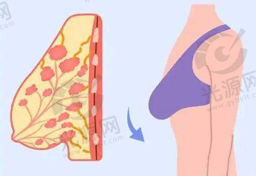 液态水分子丰胸技术的优势