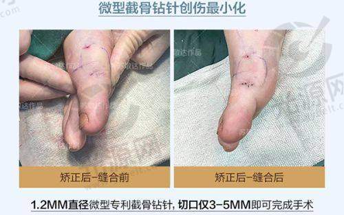 生长因子填充的长期副作用需注意