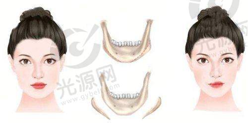 46岁能做鼻综合吗术后护理要点