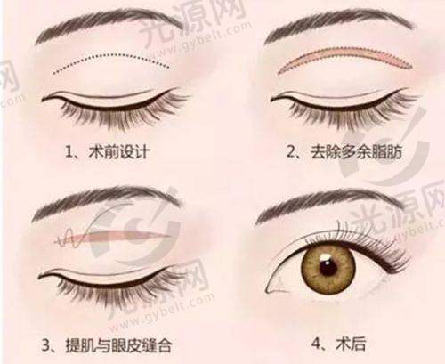 总结：德国PCL线的美丽选择