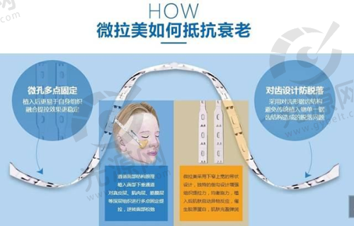 爱美客嗨体真实实例分享