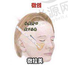 太原丽都吕新春双眼皮手术实例详解