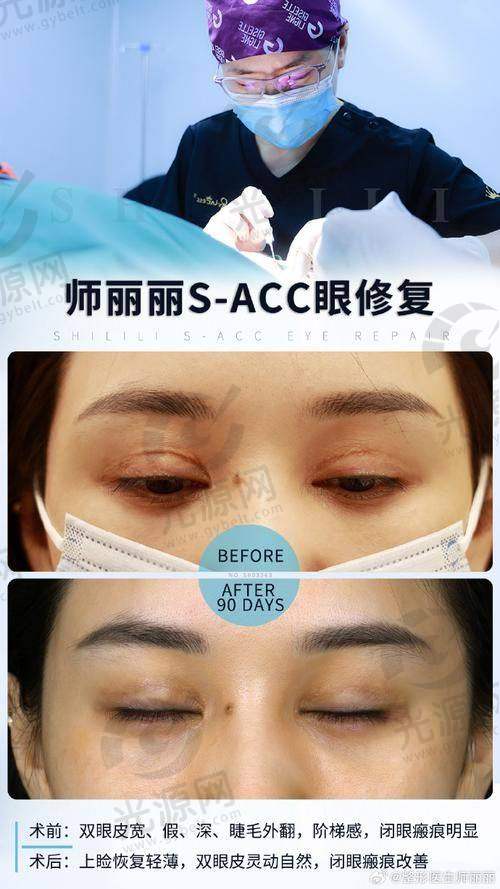 王焕医生：双眼皮修复的专精选择