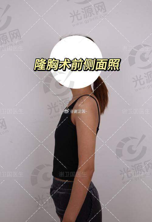 穆大力隆胸两年后结果怎么样