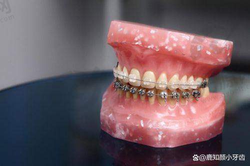 直丝mbt与roth用法区别解析：矫正效果、舒适度和适应症全面对比指南