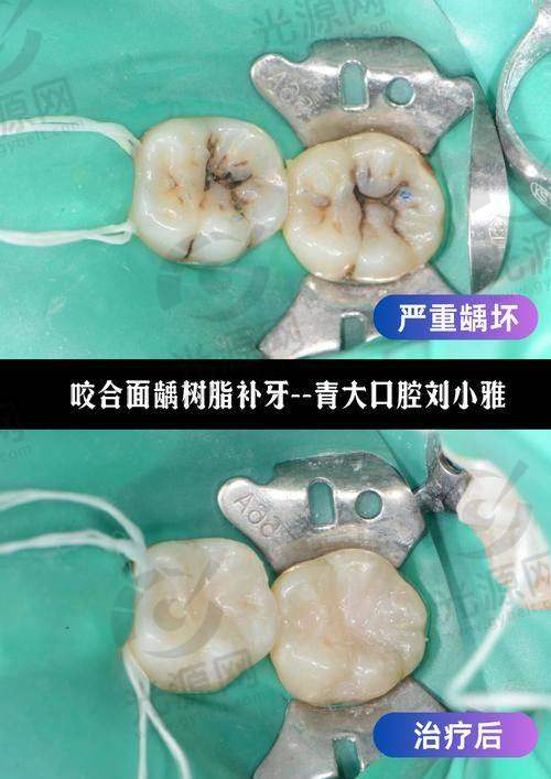 3. 根管治疗