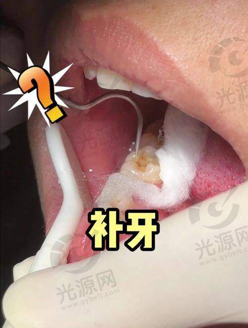 5. 洗牙