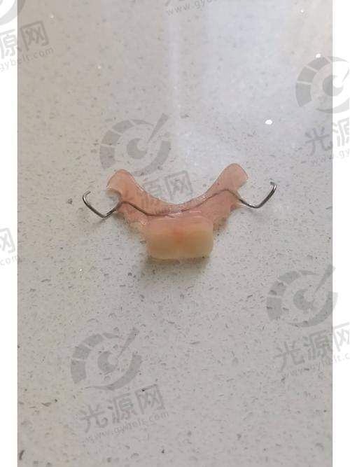 钢托义齿适合的患者群体