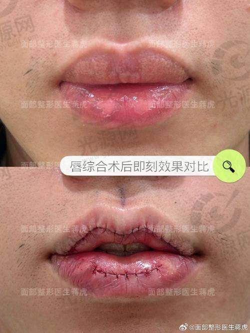 厚唇改薄手术成效的维持