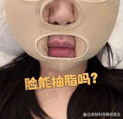 吸脂手术与明星身材管理的未来