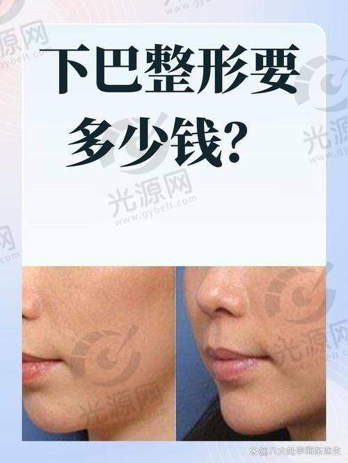 没下巴的人也可以考虑假体垫下巴