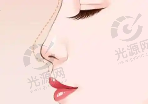 速提美手术的术后维养与成效保持
