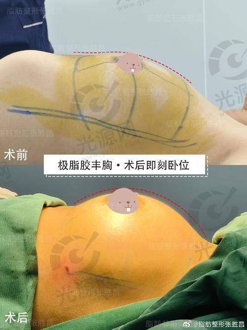 出彩医美十分钟隆胸价格与市场行情