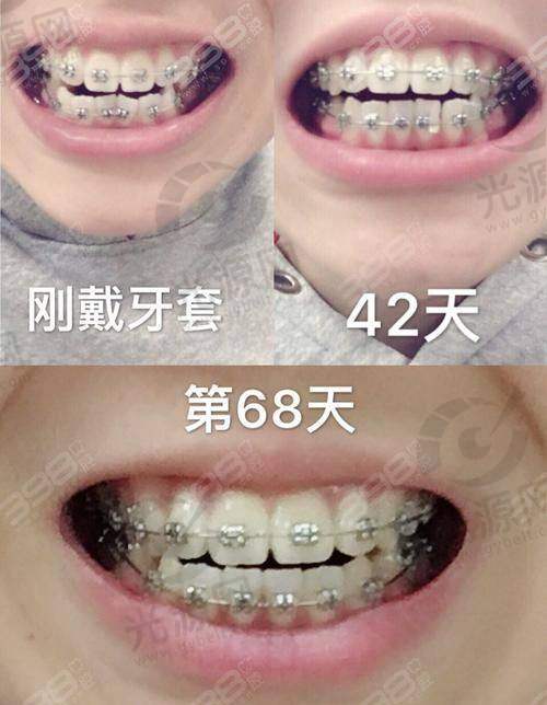 3. 隐形牙齿矫正