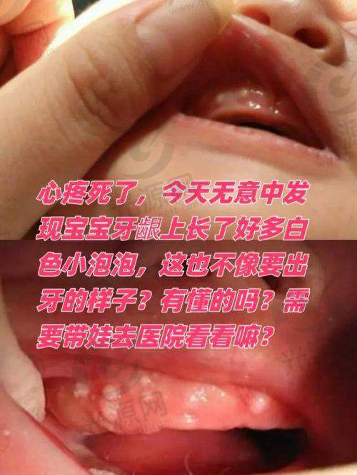 牙龈发炎的预防措施