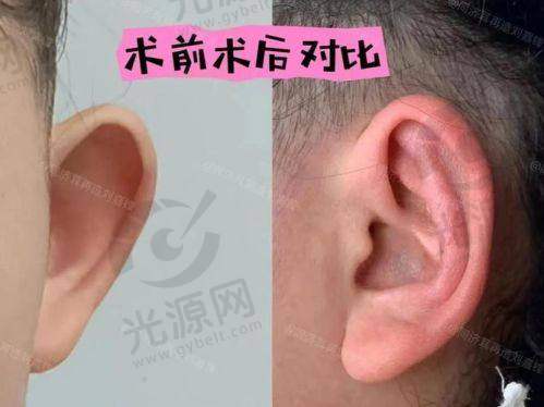 招风耳整形前后图的术后护理