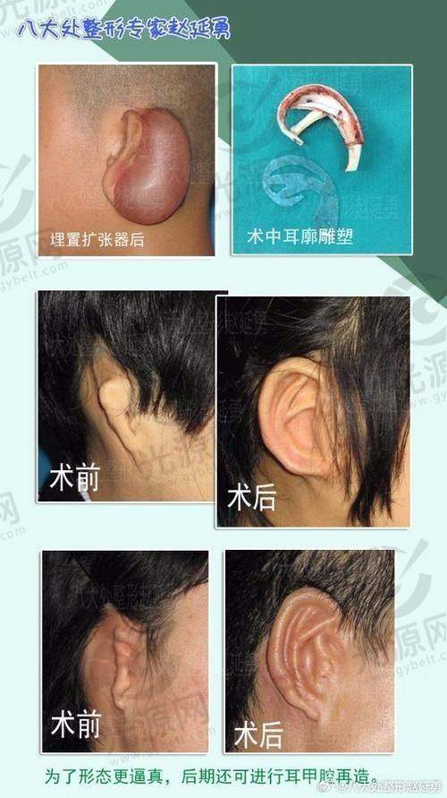招风耳整形前后图的成效与满意度