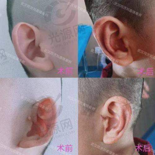 招风耳整形前后图对比实例分析