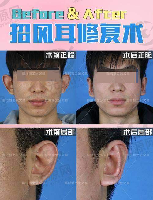 招风耳整形前后图的手术过程