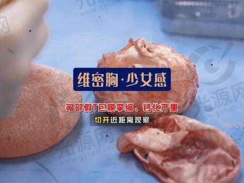 一、长沙湘雅医院注射乳房取出手术的详细介绍