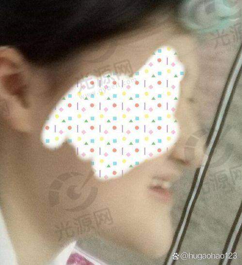 我做地包天手术后悔了：手术费用与价值的权衡