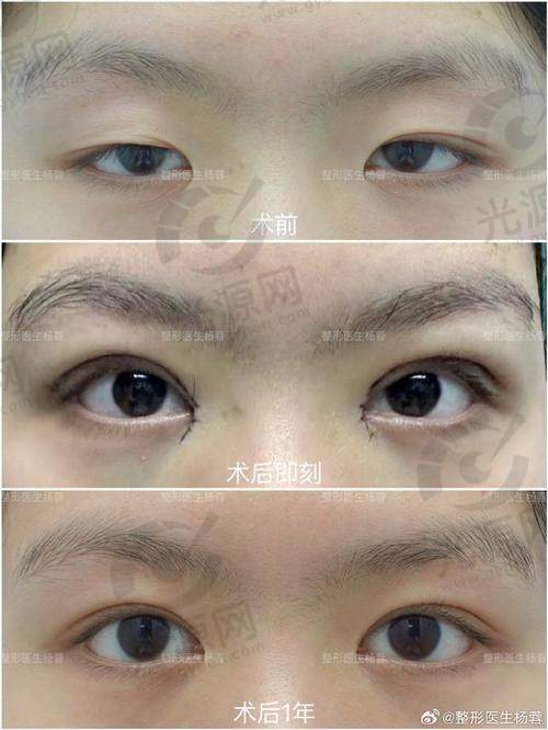 双眼皮宽度选择的技巧