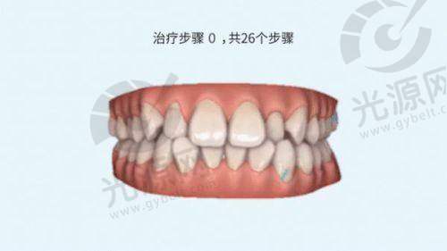 总结：合理评估矫正牙齿做口扫的费用