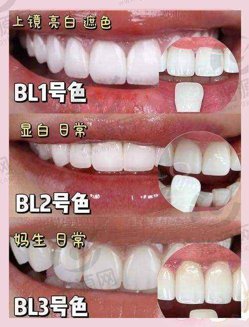 烤瓷贴面的优缺点