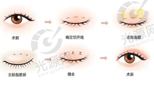 做个提眉把眼睛毁了？如何进行有效修复