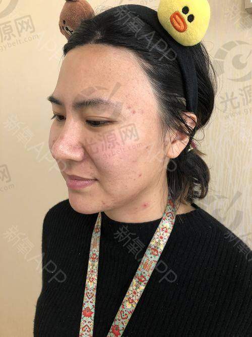 扁头变圆头成功的真实实例