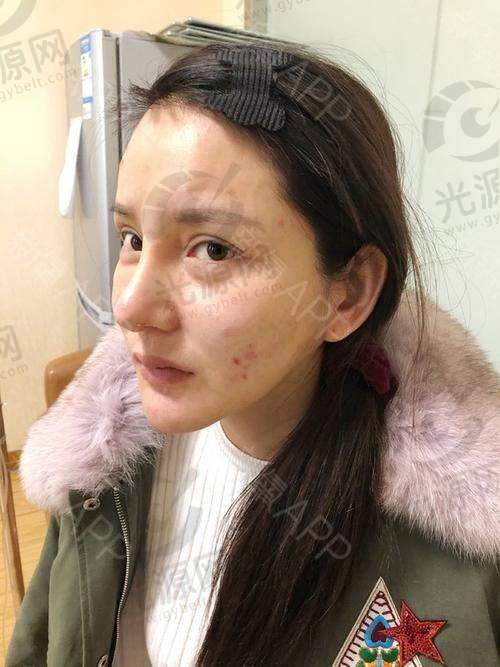 扁头变圆头整形手术成功案例解析：如何通过骨水泥填充实现头型改善与自信提升