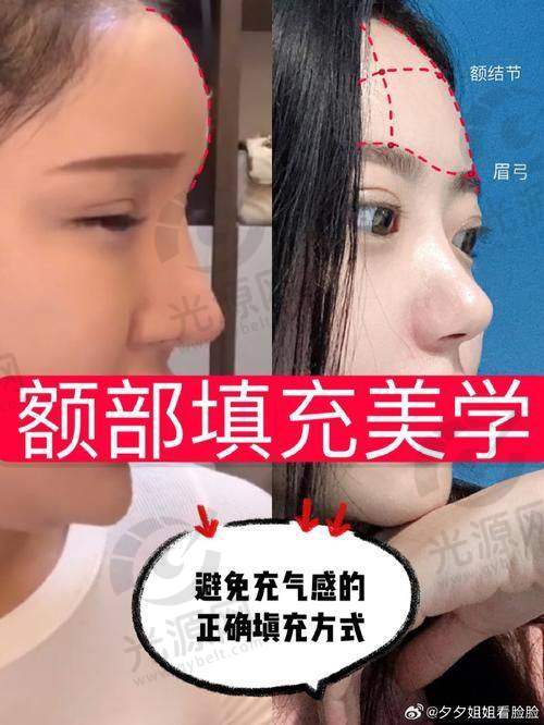 扁头变圆头成功的注意事项