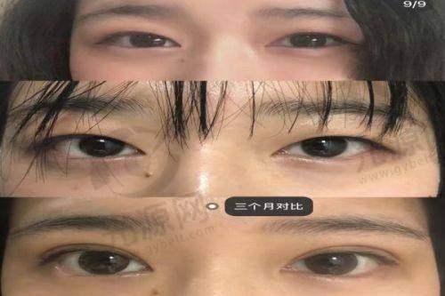 做韩国me双眼皮几百块钱：成效分析