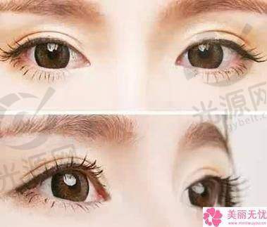 做韩国me双眼皮几百块钱：价格解析