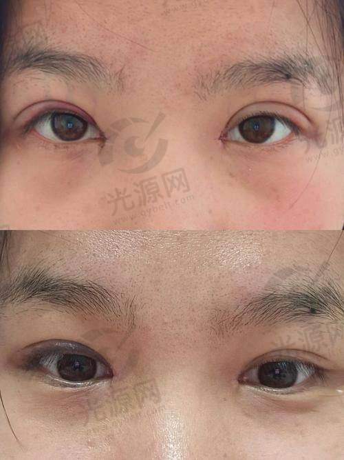 开外眼角后遗症及其应对机制