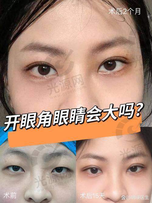 开外眼角后悔了要如何修复？